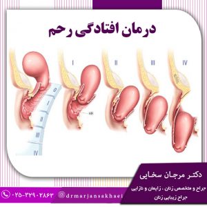 درمان افتادگی رحم