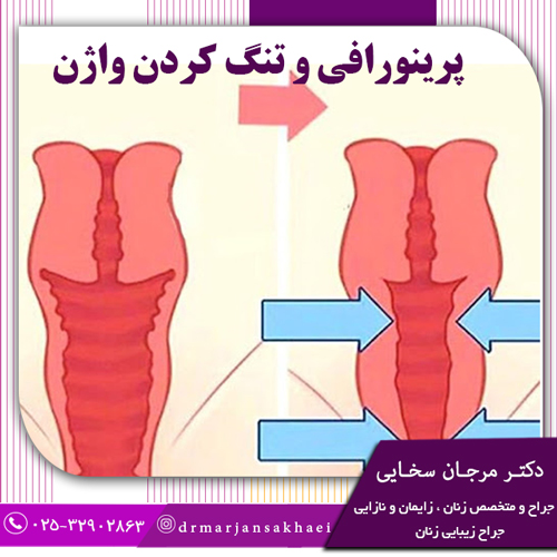 پرینورافی و تنگ کردن واژن