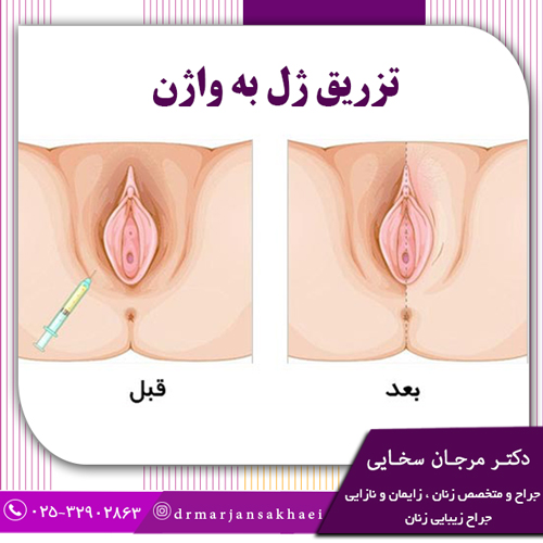 تزریق ژل به واژن
