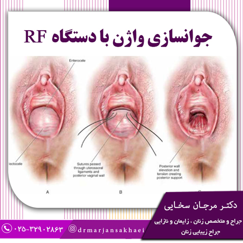 جوانسازی واژن با دستگاه RF