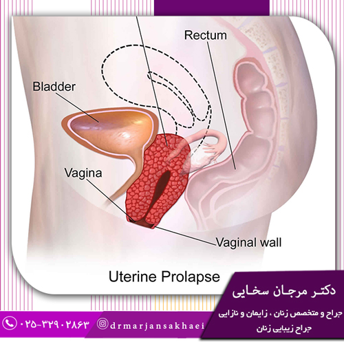 افتادگی رحم