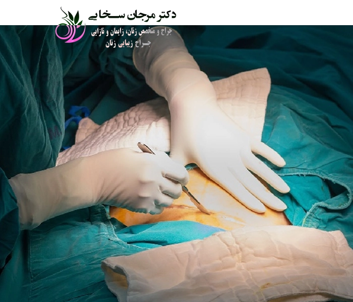 دلایل انتخاب عمل سزارین