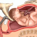 عمل سزارین چقدر طول میکشد؟