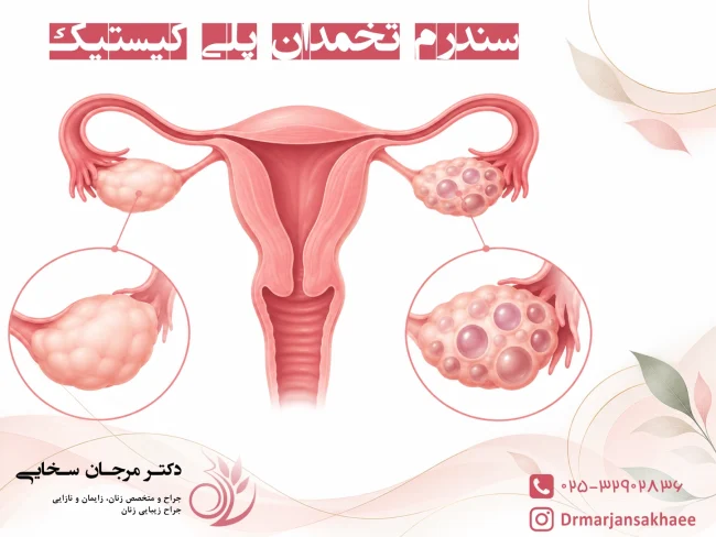سندرم تخمدان پلی کیستیک