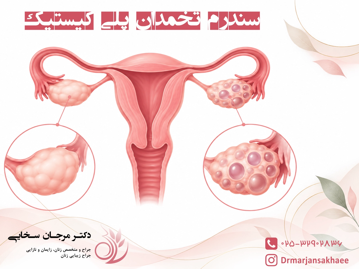 سندرم تخمدان پلی کیستیک